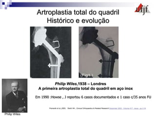 Artroplastia total do quadril
Histórico e evolução
Philip Wiles,1938 – Londres
A primeira artroplastia total do quadril em aço inox
Em 1990 :Howse , J reportou 6 casos documentados e 1 caso c/35 anos FU
Pramanik et al.,2005; Sherk HH , Clinical Orthopaedics & Related Research:December 2003 - Volume 417 - Issue - pp 3-16
Philip Wiles
 