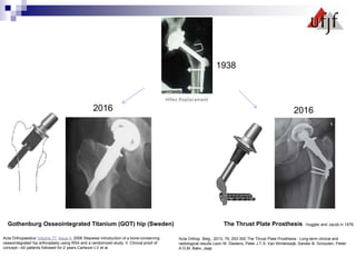 Acta Orthop. Belg., 2013, 79, 293-300 The Thrust Plate Prosthesis : Long-term clinical and
radiological results Leon W. Diederix, Peter J.T.S. Van Winterswijk, Sander B. Schouten, Pieter
A.G.M. Bakx, Jaap
Gothenburg Osseointegrated Titanium (GOT) hip (Sweden) The Thrust Plate Prosthesis Huggler and Jacob in 1978.
Acta Orthopaedica Volume 77, Issue 4, 2006 Stepwise introduction of a bone-conserving
osseointegrated hip arthroplasty using RSA and a randomized study: II. Clinical proof of
concept—40 patients followed for 2 years.Carlsoon LV et al
1938
2016
2016
 
