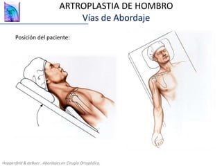 ARTROPLASTIA DE HOMBRO
Vías de Abordaje
Hoppenfeld & deBoer . Abordajes en Cirugía Ortopédica.
Posición del paciente:
 
