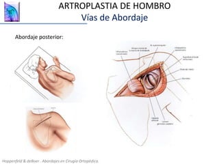 ARTROPLASTIA DE HOMBRO
Vías de Abordaje
Hoppenfeld & deBoer . Abordajes en Cirugía Ortopédica.
Abordaje posterior:
 