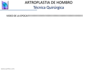 ARTROPLASTIA DE HOMBRO
Técnica Quirúrgica
www.synthes.com.
VIDEO DE LA EPOCA!!!!!!!!!!!!!!!!!!!!!!!!!!!!!!!!!!!!!!!!!!!!!!!!!!!!!!!!!!!!!!!!!!
 