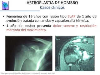 • Femenina de 16 años con lesión tipo SLAP de 1 año de
evolución tratada con anclas y capsulorrafia térmica.
• 1 año de postqx presenta dolor severo y restricción
marcada del movimiento.
The Spectrum of Shoulder Arthroplasty – Joseph P. Iannotti, MD, PhD
ARTROPLASTIA DE HOMBRO
Casos clínicos
The Spectrum of Shoulder Arthroplasty – Joseph P. Iannotti, MD, PhD
 