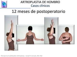 12 meses de postoperatorio
The Spectrum of Shoulder Arthroplasty – Joseph P. Iannotti, MD, PhD
ARTROPLASTIA DE HOMBRO
Casos clínicos
The Spectrum of Shoulder Arthroplasty – Joseph P. Iannotti, MD, PhD
 