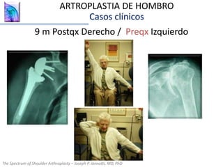 9 m Postqx Derecho / Preqx Izquierdo
The Spectrum of Shoulder Arthroplasty – Joseph P. Iannotti, MD, PhD
ARTROPLASTIA DE HOMBRO
Casos clínicos
 