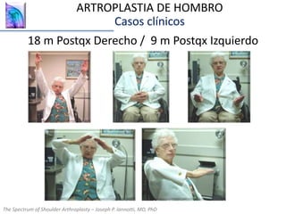 The Spectrum of Shoulder Arthroplasty – Joseph P. Iannotti, MD, PhD
18 m Postqx Derecho / 9 m Postqx Izquierdo
The Spectrum of Shoulder Arthroplasty – Joseph P. Iannotti, MD, PhD
ARTROPLASTIA DE HOMBRO
Casos clínicos
 