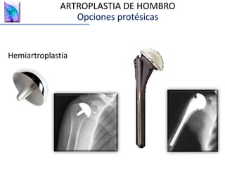 Hemiartroplastia
ARTROPLASTIA DE HOMBRO
Opciones protésicas
 