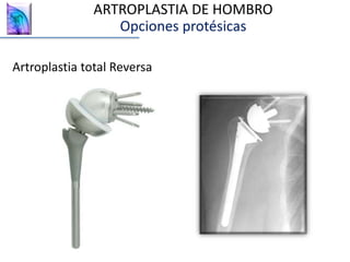 Artroplastia total Reversa
ARTROPLASTIA DE HOMBRO
Opciones protésicas
 