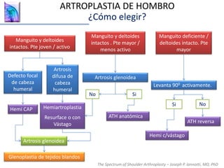 Manguito y deltoides
intactos. Pte joven / activo
Manguito y deltoides
intactos . Pte mayor /
menos activo
Manguito deficiente /
deltoides intacto. Pte
mayor
Artrosis glenoidea
ATH anatómica
Defecto focal
de cabeza
humeral
Artrosis
difusa de
cabeza
humeral
Artrosis glenoidea
Hemiartroplastia
Resurface o con
Vástago
Hemi CAP
Glenoplastia de tejidos blandos
ATH reversa
Hemi c/vástago
Levanta 900 activamente.
Si No
No Si
The Spectrum of Shoulder Arthroplasty – Joseph P. Iannotti, MD, PhD
ARTROPLASTIA DE HOMBRO
¿Cómo elegir?
 
