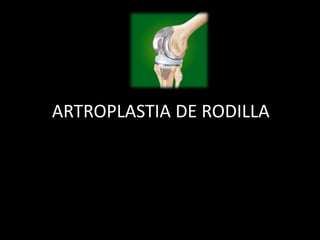 ARTROPLASTIA DE RODILLA
 