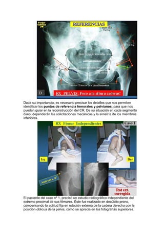 Dada su importancia, es necesario precisar los detalles que nos permiten
identificar los puntos de referencia femorales y pelvianos, para que nos
puedan guiar en la reconstrucción del CR. De su situación en cada segmento
óseo, dependerán las solicitaciones mecánicas y la simetría de los miembros
inferiores.




El paciente del caso nº 1, precisó un estudio radiográfico independiente del
extremo proximal de sus fémures. Éste fue realizado en decúbito prono,
compensando la actitud fija en rotación externa de la cadera derecha con la
posición oblicua de la pelvis, como se aprecia en las fotografías superiores.
 