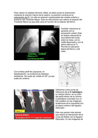 Para valorar el voladizo femoral- offset, se debe anular la anteversión;
mediante la rotación interna de la cadera. La posición correcta es la
anteversión de 0º; con ella se aprecian superpuestas las crestas anterior y
posterior del Trocánter Mayor. Esto es más preciso que valorar el aspecto del
Trocánter Menor ya que éste varia en función de la rotación del fémur.


                                                       También valoramos al
                                                       paciente con la
                                                       proyección uretral. Esta
                                                       se realiza colocando la
                                                       cara lateral del muslo
                                                       sobre la mesa, con la
                                                       rodilla flexionada y con la
                                                       pelvis oblicua en ¾.
                                                       Permite la valoración
                                                       lateral del fémur y del
                                                       cotilo.




Con el falso perfil de Lequesne, en
bipedestación, se evidencia la displasia
acetabular. No suele ser visible en AP; ya que
suele ser anterior.




                                                 Utilizamos como punto de
                                                 referencia de la U radiológica
                                                 su vértice inferior: en la unión
                                                 del perfil inferior de la Lámina
                                                 Cuadrilátera (marcada con un
                                                 hilo metálico en las imágenes
                                                 anatómicas de la izquierda) con
                                                 el súpero externo del Agujero
                                                 Obturador.

                                                 Esto nos parece más preciso
                                                 que utilizar la intersección de la
                                                 Línea de Köhler con el Agujero
                                                 Obturador. En las imágenes de
 