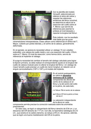 Con la plantilla del modelo
                                                   Versys®, seleccionada por
                                                   rellenar el istmo del calcar y
                                                   respetar las relaciones
                                                   simétricas del fémur proximal,
                                                   se determina la altura de la
                                                   resección del cuello sobre el
                                                   T. Menor; que servirá de
                                                   referencia para asentar la
                                                   prótesis al nivel deseado y
                                                   repectar la longitud del fémur.

                                                  Éste método, nos ha resultado
                                                  más fiable que las guías
intramedulares intraoperatorias. Éstas utilizan como referencias el vértice del T.
Mayor, cubierto por partes blandas, y el centro de la cabeza, generalmente
deformada.

En el ejemplo, se aprecia la necesidad utilizar un vástago 15 con voladizo
extendido, una cabeza de cuello medio y con una resección del cuello +3'5cm.
sobre el T. Menor. El nivel de resección, como hemos dicho, servirá de
referencia al implantar el vástago.

Si surge la necesidad de cambiar el tamaño del vástago calculado para lograr
la fijación primaria, se debe realizar el correspondiente ajuste en la longitud del
cuello de cabeza modular para no alterar la longitud del fémur. Un vástago de
mayor tamaño suele precisar un cuello de menor longitud, en relación con el
ángulo cervicodiafisario (135º ó 130º) y el modelo del implante.

                                                   En el control postoperatorio,
                                                   se valora la dismetría
                                                   intrínseca de la cadera,
                                                   comparando las alturas del
                                                   centro de la cabeza en el
                                                   fémur y la del centro del cotilo
                                                   en la pelvis, de cada lado:

                                                   i -i' Altura TM al centro de la cabeza

                                                   a-a' Altura CR de la pelvis a línea
                                                        de las U

                                                 La valoración independiente
                                                 de la altura en cada
componente permite precisar la corrección realizada sobre las anomalías
preexistentes.
   En este caso, se logró un alargamiento del fémur derecho de 0'34 cm. y un
descenso del CR derecho de 1'17 cm. Con ello, la hipometría radiológica de 2'3
cm., que existía en la cadera derecha, se redujo a 0'8 cm. Se aprecia, además,
que se logró una buena medialización del CR en la pelvis.
 