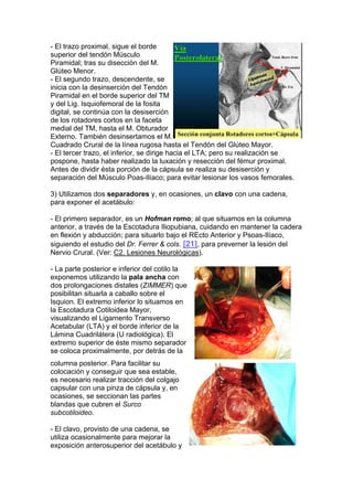 - El trazo proximal, sigue el borde
superior del tendón Músculo
Piramidal; tras su disección del M.
Glúteo Menor.
- El segundo trazo, descendente, se
inicia con la desinserción del Tendón
Piramidal en el borde superior del TM
y del Lig. Isquiofemoral de la fosita
digital, se continúa con la desiserción
de los rotadores cortos en la faceta
medial del TM, hasta el M. Obturador
Externo. También desinsertamos el M.
Cuadrado Crural de la línea rugosa hasta el Tendón del Glúteo Mayor.
- El tercer trazo, el inferior, se dirige hacia el LTA; pero su realización se
pospone, hasta haber realizado la luxación y resección del fémur proximal.
Antes de dividir ésta porción de la cápsula se realiza su desiserción y
separación del Músculo Poas-Ilíaco; para evitar lesionar los vasos femorales.

3) Utilizamos dos separadores y, en ocasiones, un clavo con una cadena,
para exponer el acetábulo:

- El primero separador, es un Hofman romo; al que situamos en la columna
anterior, a través de la Escotadura Iliopubiana, cuidando en mantener la cadera
en flexión y abducción; para situarlo bajo el REcto Anterior y Psoas-Ilíaco,
siguiendo el estudio del Dr. Ferrer & cols. [21], para preverner la lesión del
Nervio Crural. (Ver: C2. Lesiones Neurológicas).

- La parte posterior e inferior del cotilo la
exponemos utilizando la pala ancha con
dos prolongaciones distales (ZIMMER) que
posibilitan situarla a caballo sobre el
Isquion. El extremo inferior lo situamos en
la Escotadura Cotiloidea Mayor,
visualizando el Ligamento Transverso
Acetabular (LTA) y el borde inferior de la
Lámina Cuadrilátera (U radiológica). El
extremo superior de éste mismo separador
se coloca proximalmente, por detrás de la
columna posterior. Para facilitar su
colocación y conseguir que sea estable,
es necesario realizar tracción del colgajo
capsular con una pinza de cápsula y, en
ocasiones, se seccionan las partes
blandas que cubren el Surco
subcotiloideo.

- El clavo, provisto de una cadena, se
utiliza ocasionalmente para mejorar la
exposición anterosuperior del acetábulo y
 