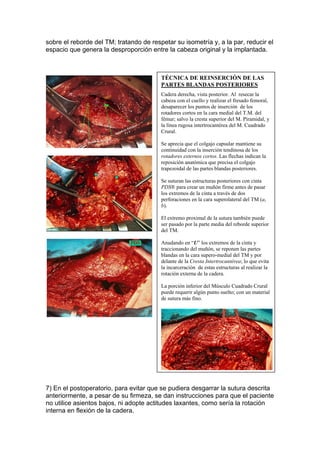 sobre el reborde del TM; tratando de respetar su isometría y, a la par, reducir el
espacio que genera la desproporción entre la cabeza original y la implantada.



                                         TÉCNICA DE REINSERCIÓN DE LAS
                                         PARTES BLANDAS POSTERIORES
                                         Cadera derecha, vista posterior. Al resecar la
                                         cabeza con el cuello y realizar el fresado femoral,
                                         desaparecer los puntos de inserción de los
                                         rotadores cortos en la cara medial del T.M. del
                                         fémur; salvo la cresta superior del M. Piramidal, y
                                         la línea rugosa intertrocantérea del M. Cuadrado
                                         Crural.

                                         Se aprecia que el colgajo capsular mantiene su
                                         continuidad con la inserción tendinosa de los
                                         rotadores externos cortos. Las flechas indican la
                                         reposición anatómica que precisa el colgajo
                                         trapezoidal de las partes blandas posteriores.

                                         Se suturan las estructuras posteriores con cinta
                                         PDS® para crear un muñón firme antes de pasar
                                         los extremos de la cinta a través de dos
                                         perforaciones en la cara superolateral del TM (a,
                                         b).

                                         El extremo proximal de la sutura también puede
                                         ser pasado por la parte media del reborde superior
                                         del TM.

                                         Anudando en “U” los extremos de la cinta y
                                         traccionando del muñón, se reponen las partes
                                         blandas en la cara supero-medial del TM y por
                                         delante de la Cresta Intertrocantérea; lo que evita
                                         la incarceración de estas estructuras al realizar la
                                         rotación externa de la cadera.

                                         La porción inferior del Músculo Cuadrado Crural
                                         puede requerir algún punto suelto; con un material
                                         de sutura más fino.




7) En el postoperatorio, para evitar que se pudiera desgarrar la sutura descrita
anteriormente, a pesar de su firmeza, se dan instrucciones para que el paciente
no utilice asientos bajos, ni adopte actitudes laxantes, como sería la rotación
interna en flexión de la cadera.
 