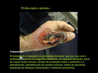 10 dias após a picada... Tratamento: O tratamento é baseado na gravidade da lesão, que por sua vez é avaliado  con forme os seguintes critérios: no aspecto da lesão, local do corpo onde ocorreu, tempo de evolução entre o acidente e o atendimento, identificação da aranha marrom, idade do paciente, presença de doenças associadas e sintomas presentes.   