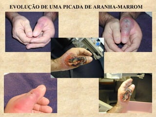 EVOLUÇÃO DE UMA PICADA DE ARANHA-MARROM
 