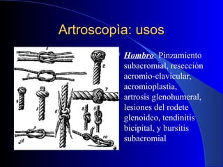 Artroscopìa: usos
 Hombro:

Pinzamiento
subacromial, resección
acromio-clavicular,
acromioplastìa,
artrosis glenohumeral,
lesiones del rodete
glenoideo, tendinitis
bicipital, y bursitis
subacromial

 