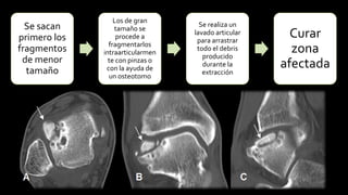 Se sacan primero los fragmentos de menor tamaño 
Los de gran tamaño se procede a fragmentarlos intraarticularmentecon pinzas o con la ayuda de un osteotomo 
Se realiza un lavado articular para arrastrar todo el debris producido durante la extracción 
Curar zona afectada  