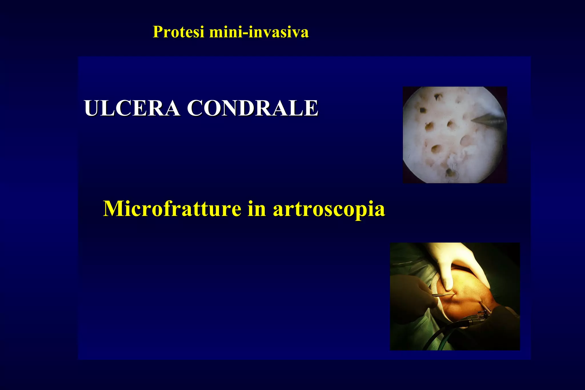 Passasuture Artroscopico "Ginocchio Scorpione" – Strumento Ortopedico HASSAN-RAZA-SURGICAL