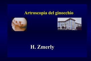 Artroscopia del ginocchioArtroscopia del ginocchio
H. ZmerlyH. Zmerly
 