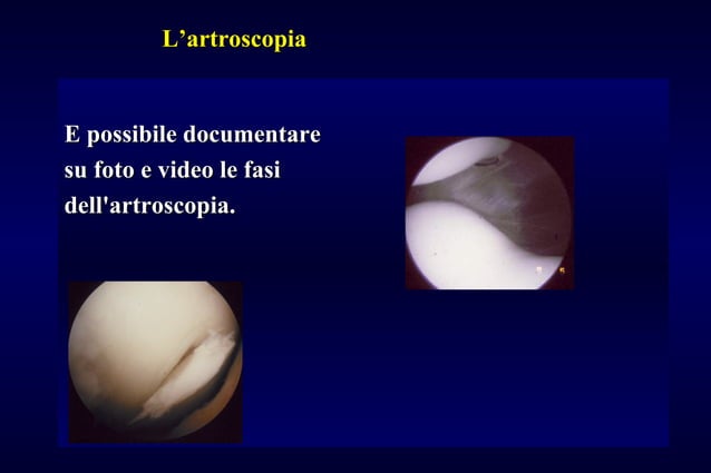 Arthrex AR-12990 Ginocchio Scorpione Sutura Passer Arthrex AR-12990 Ginocchio Scorpione Sutura Passer