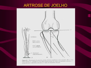 ARTROSE DE JOELHO
 