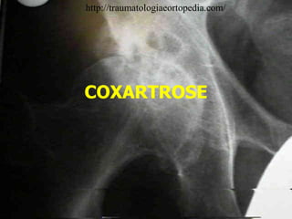 COXARTROSE
http://traumatologiaeortopedia.com/
 