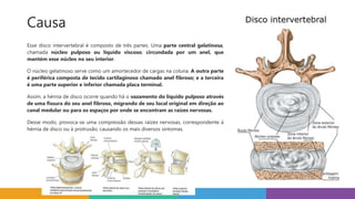 Causa
Esse disco intervertebral é composto de três partes. Uma parte central gelatinosa,
chamada núcleo pulposo ou líquido viscoso, circundada por um anel, que
mantém esse núcleo no seu interior.
O núcleo gelatinoso serve como um amortecedor de cargas na coluna. A outra parte
é periférica composta de tecido cartilaginoso chamado anel fibroso; e a terceira
é uma parte superior e inferior chamada placa terminal.
Assim, a hérnia de disco ocorre quando há o vazamento do líquido pulposo através
de uma fissura do seu anel fibroso, migrando de seu local original em direção ao
canal medular ou para os espaços por onde se encontram as raízes nervosas.
Desse modo, provoca-se uma compressão dessas raízes nervosas, correspondente à
hérnia de disco ou à protrusão, causando os mais diversos sintomas.
 