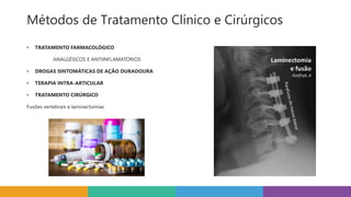 Métodos de Tratamento Clínico e Cirúrgicos
• TRATAMENTO FARMACOLÓGICO
ANALGÉSICOS E ANTIINFLAMATÓRIOS
• DROGAS SINTOMÁTICAS DE AÇÃO DURADOURA
• TERAPIA INTRA-ARTICULAR
• TRATAMENTO CIRÚRGICO
Fusões vertebrais e laminectomias
 
