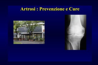 Artrosi : Prevenzione e CureArtrosi : Prevenzione e Cure
 
