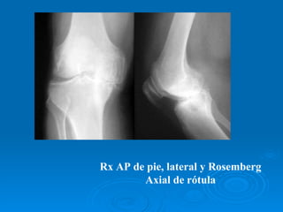 Rotula Axial Rx Artrosis | PPT