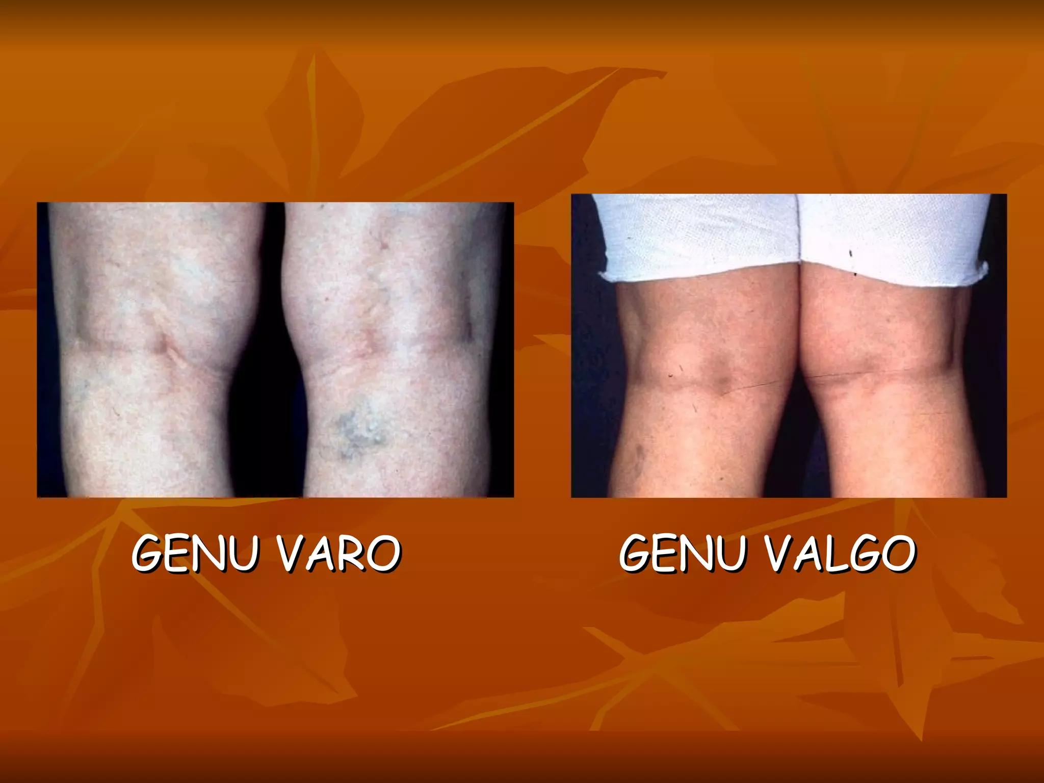 GENU VARO  GENU VALGO 