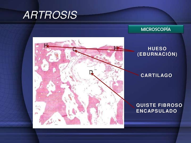 artrosis fisiopatologia e histologia training presentation outline