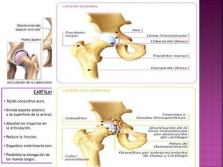 artrosis cadera | PPTX