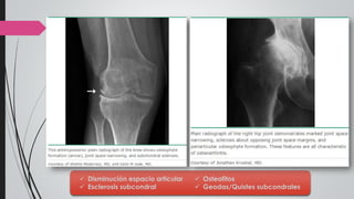  Disminución espacio articular
 Esclerosis subcondral
 Osteofitos
 Geodas/Quistes subcondrales
 