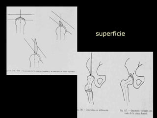 superficie 