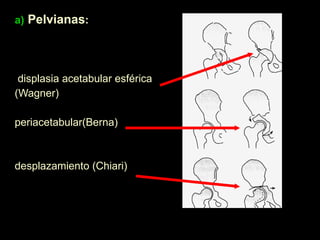 a)  Pelvianas : displasia acetabular esférica (Wagner)  periacetabular(Berna)  desplazamiento (Chiari) 
