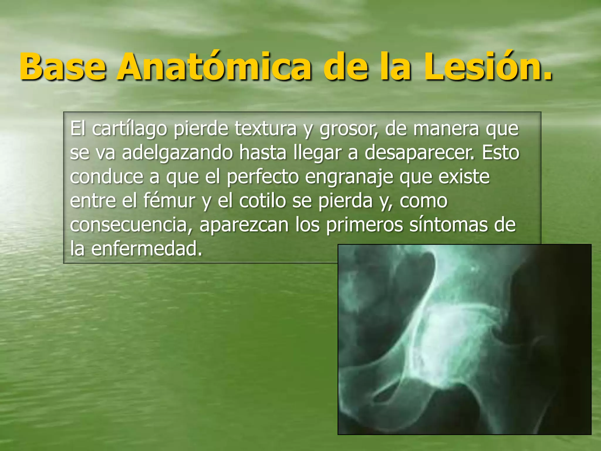 Artrosis de cadera | PPT