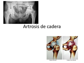 Artrosis de cadera
 