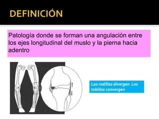 Patología donde se forman una angulación entre
los ejes longitudinal del muslo y la pierna hacia
adentro




                              Las rodillas divergen Los
                              tobillos convergen
 