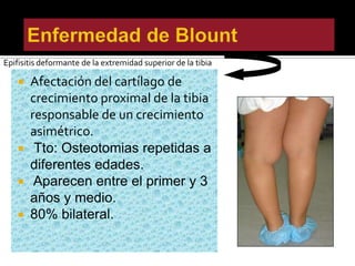 TIBIA VARA SUPERIOR




Epifisitis deformante de la extremidad superior de la tibia

     Afectación del cartílago de
      crecimiento proximal de la tibia
      responsable de un crecimiento
      asimétrico.
     Tto: Osteotomias repetidas a
      diferentes edades.
     Aparecen entre el primer y 3
      años y medio.
     80% bilateral.
 