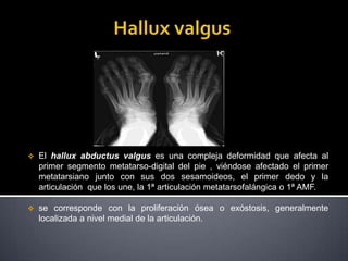    El hallux abductus valgus es una compleja deformidad que afecta al
    primer segmento metatarso-digital del pie , viéndose afectado el primer
    metatarsiano junto con sus dos sesamoideos, el primer dedo y la
    articulación que los une, la 1ª articulación metatarsofalángica o 1ª AMF.

   se corresponde con la proliferación ósea o exóstosis, generalmente
    localizada a nivel medial de la articulación.
 