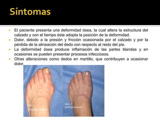  El paciente presenta una deformidad ósea, la cual altera la estructura del
  calzado y con el tiempo éste adopta la posición de la deformidad.
 Dolor, debido a la presión y fricción ocasionada por el calzado y por la
  pérdida de la alineación del dedo con respecto al resto del pie.
 La deformidad ósea produce inflamación de las partes blandas y en
  ocasiones se pueden presentar procesos infecciosos.
 Otras alteraciones como dedos en martillo, que contribuyen a ocasionar
  dolor.
 