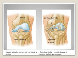 Espacio articular normal entre el fémur y    Espacio articular reducido debido al
la tibia.                                   cartílago dañado y espolones.
 