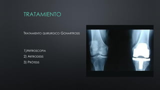 TRATAMIENTO
TRATAMIENTO QUIRURGICO GONARTROSIS
1)ARTROSCOPIA
2) ARTRODESIS
3) PRÓTESIS
 