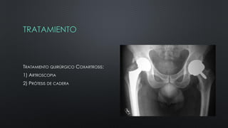 TRATAMIENTO
TRATAMIENTO QUIRÚRGICO COXARTROSIS:
1) ARTROSCOPIA
2) PRÓTESIS DE CADERA
 