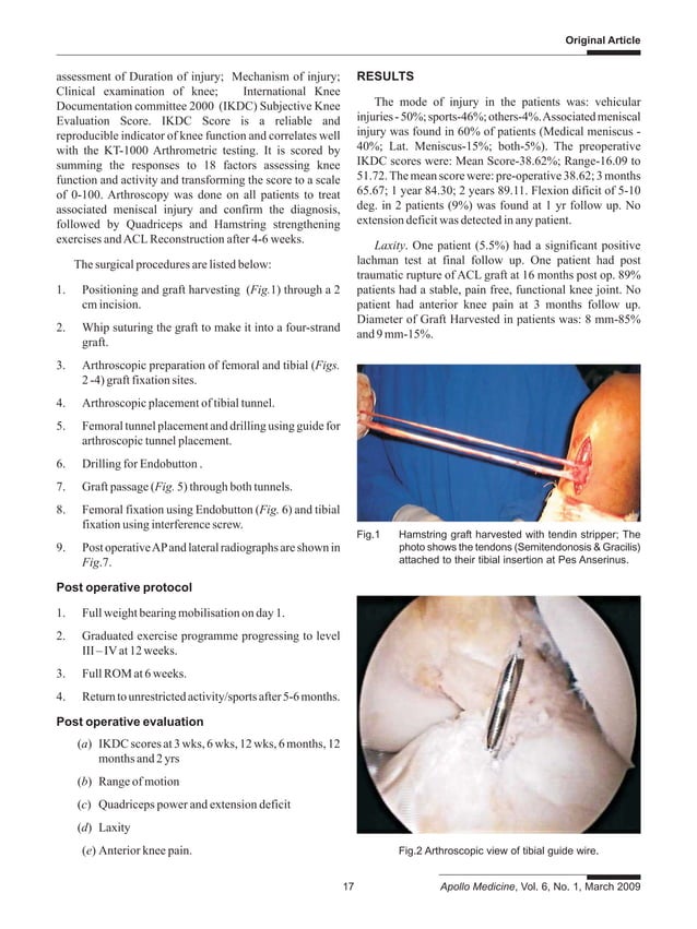Arthroscopic Anterior Cruciate Ligament Reconstruction Using FourStrand Hamstring Graft A