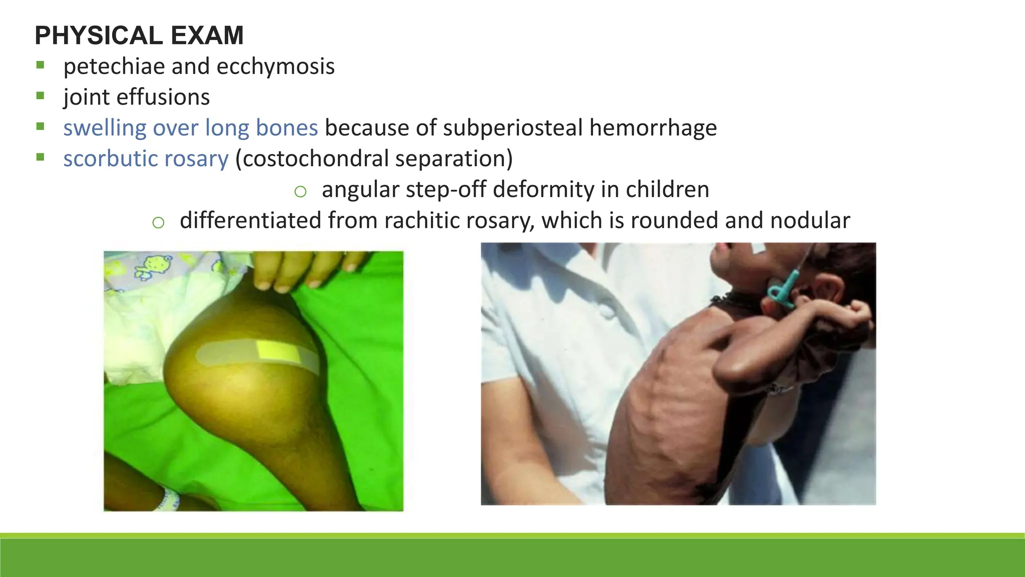 METABOLIC BONE DISEASES - Rickets, Scurvy, Osteomalacia. | PPTX