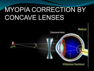 spectacle refraction versus ocular refraction | PPTX