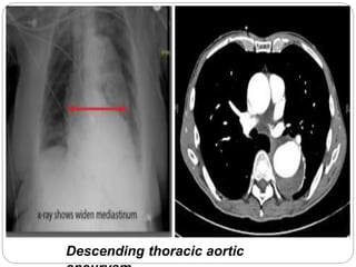 Descending thoracic aortic 
aneurysm. 
 